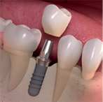 dental-implants-1